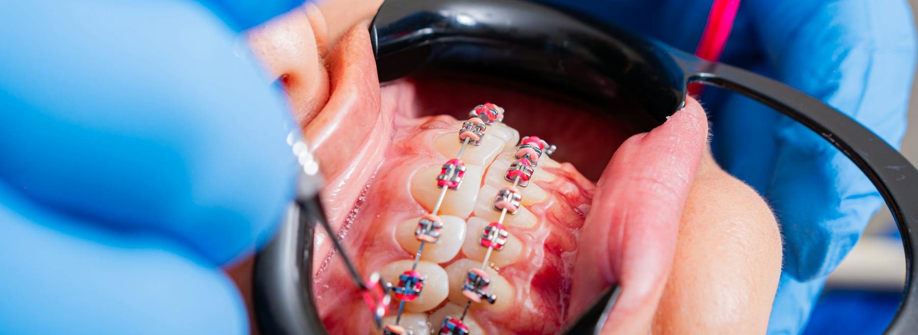 dentist working on patient teeth with brackets